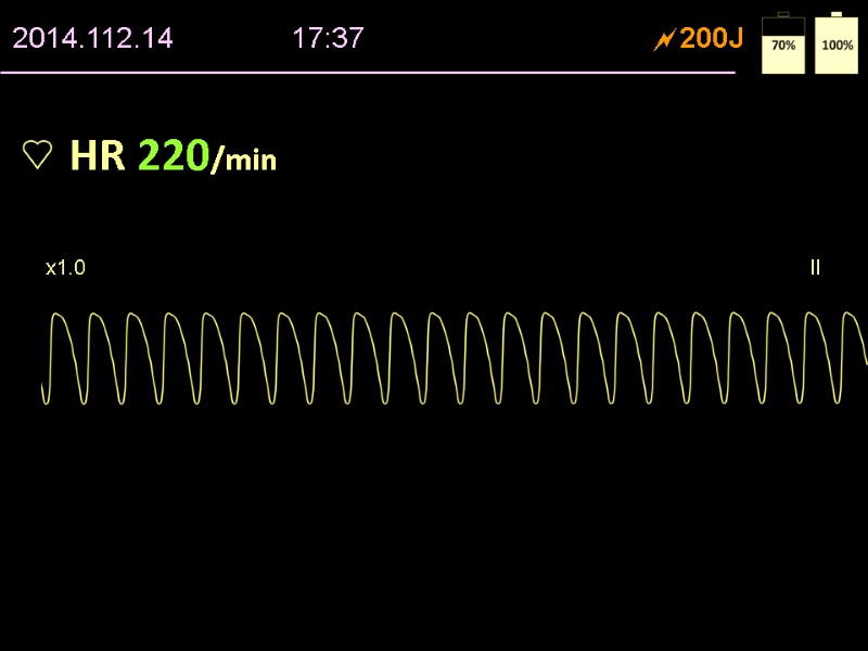 HR 220/min x1.0           